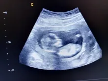 Ultrasound scan of 15 week-old baby.